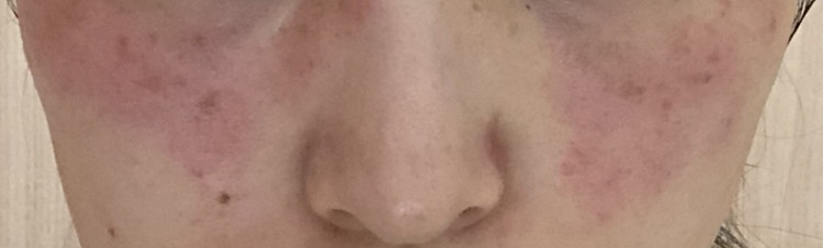 シミとりレーザー治療 本気のレポ ローリエプレス