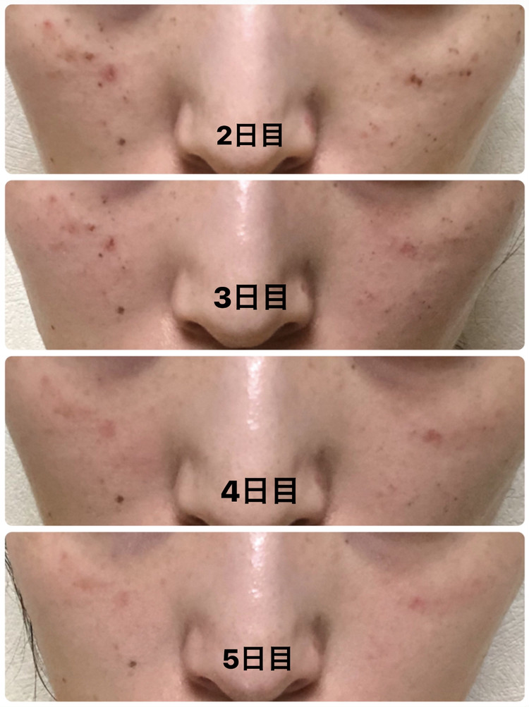 シミとりレーザー治療 本気のレポ ローリエプレス