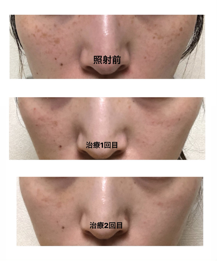 シミとりレーザー治療 本気のレポ ローリエプレス