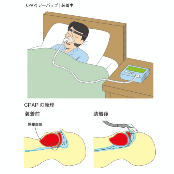 マツコのいびきにミッツ この人 死ぬんじゃないか ひとり寝だと気づかない 睡眠時無呼吸症候群 15年7月21日 エキサイトニュース