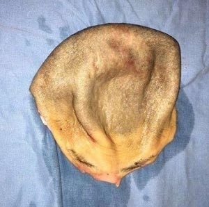 閲覧注意 機械に髪が巻き込まれ 頭皮まるごとズルッ 中国人女性が0針を縫う大ケガ 17年2月23日 エキサイトニュース 閲覧注意 機械に髪が巻き込まれ 頭皮まるごとズルッ 中国人女性が0針を縫う大ケガ 17年2月23日 エキサイトニュース