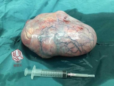 12歳女児の卵巣から6キロの異物が 中国で リアルピノコ 巨大奇形腫の出現が相次ぐ 17年5月17日 エキサイトニュース