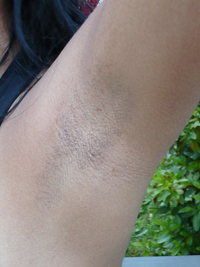 ワキの黒ずみは突然できることも 皮膚科医が 肌トラブルを起こさないためのワキ毛処理を解説 17年2月11日 エキサイトニュース