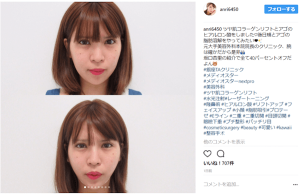 坂口杏里 インスタでプチ整形を告白するも 生々しい部分 に注目が集まり騒然 17年8月19日 エキサイトニュース