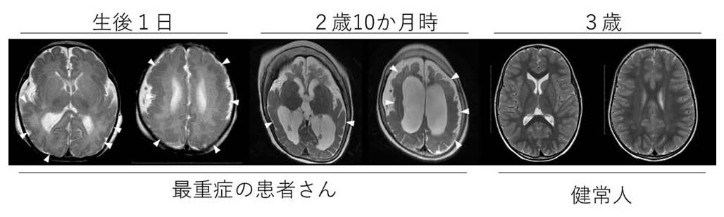 大脳皮質形成異常症の１つである「多小脳回」（病的に小さい脳回が多発する病気）の新たな原因遺伝子ATP1A3を同定 (2021年3月25日) -  エキサイトニュース