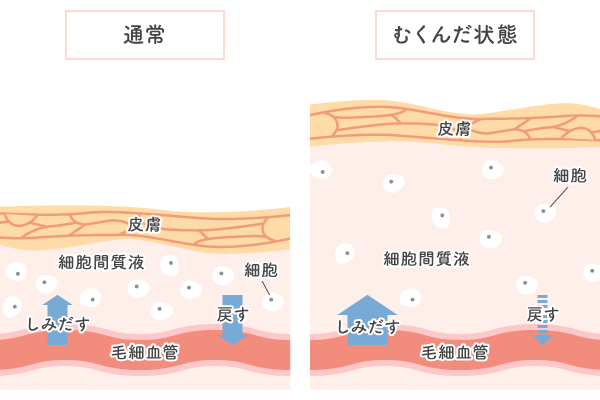 生理前 生理中にむくみが出る原因 年10月28日 エキサイトニュース