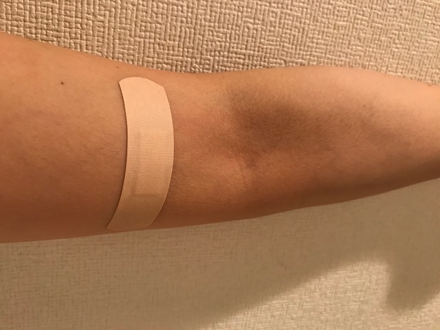 アルコールパッチテストって どの程度正確なの エキサイトニュース