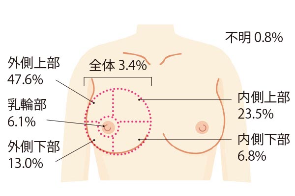 40才で発覚 遺伝性乳がんサバイバーの体験談 気付いたきっかけ 治療方法は ローリエプレス