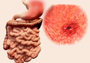 胃がん 症状 ピロリ菌 胃がん 症状 ピロリ菌