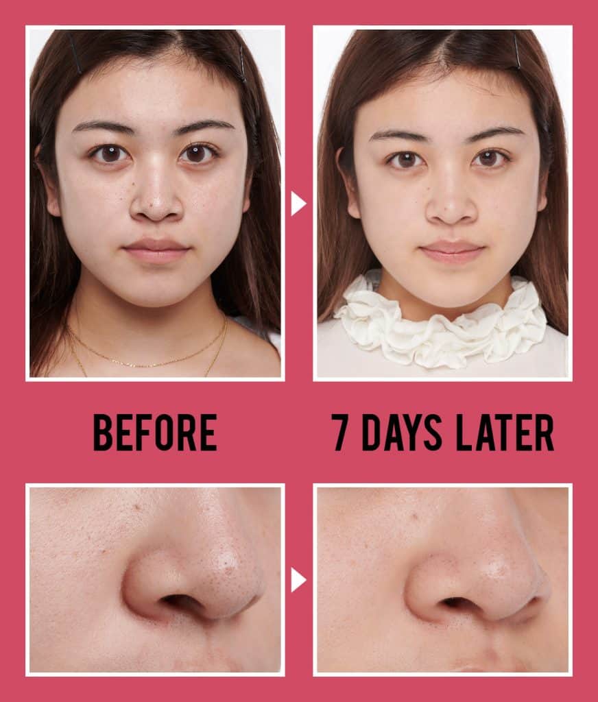 敏感肌だってok 専門家監修 1週間でオススメ黒ずみ毛穴撃退 試してみた ローリエプレス