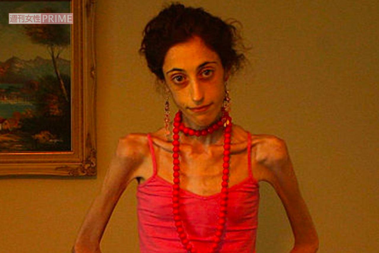 コロナ禍で急増する やせ願望 無理なダイエットが招く 摂食障害 の苦しみ 21年8月21日 エキサイトニュース