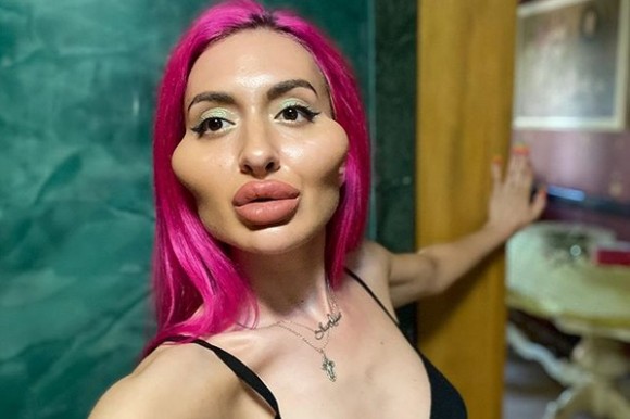 後悔はしていない 自分の理想はこの形 頬骨を強調するための整形を繰り返す女性 ウクライナ 年7月11日 エキサイトニュース