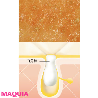 あなたの毛穴タイプは 特徴 原因を知って春先のお悩み肌から脱出 ローリエプレス