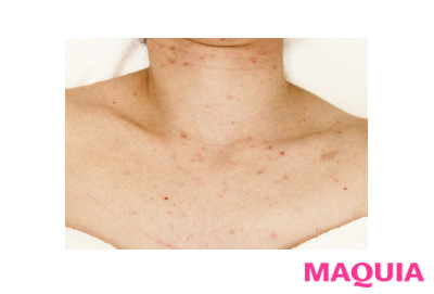 薄着の季節こそ徹底ケア プロが教えるボディの毛穴トラブル撃退法 ローリエプレス