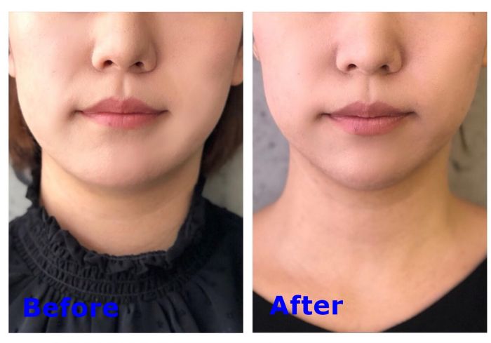 マリコール の輪郭彫刻美容液で小顔になれるのか 1か月ガチお試し ローリエプレス