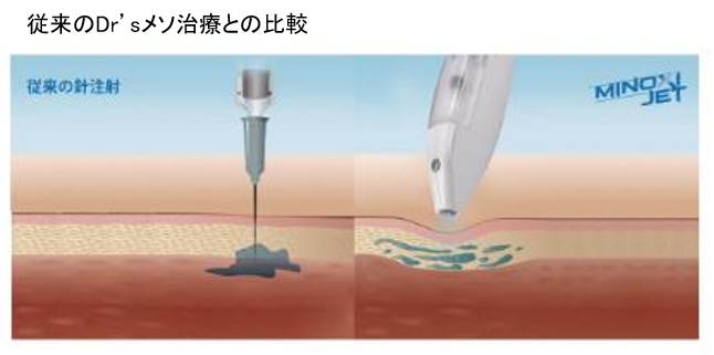 注射を使わず 高圧エアで頭皮に浸透注入 Agaスキンクリニックが痛くない発毛治療 ミノキジェット を日本初導入 19年7月18日 エキサイトニュース