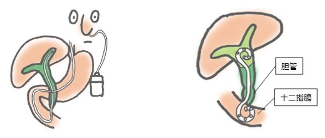 胆管ドレナージとは何ですか?