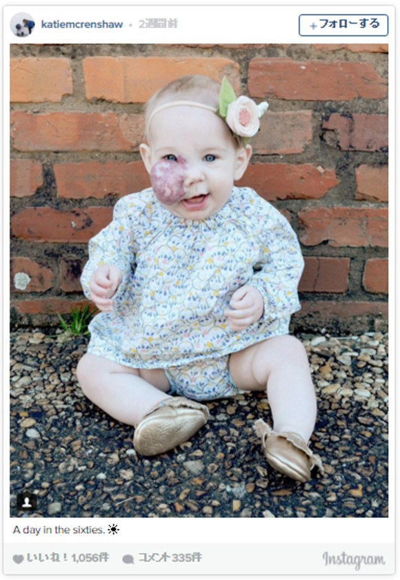 顔に 大きなイチゴ のようなアザがある赤ちゃんの写真をインスタグラムにシェアし続けるお母さん その理由が感動的 と話題 16年3月18日 エキサイトニュース