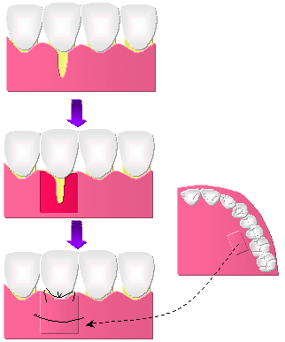 「歯のすきまが気になる…」マツコも受けた、歯茎の移植手術って？