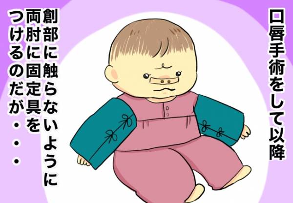 抑制帯を固定する方法を模索！【口唇口蓋裂ちゃん、育ててます98】(2020年8月4日)｜ウーマンエキサイト(1/2)