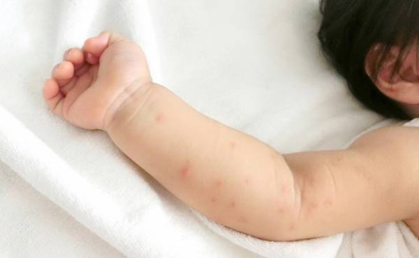 幼児の発熱後の一般的な発疹