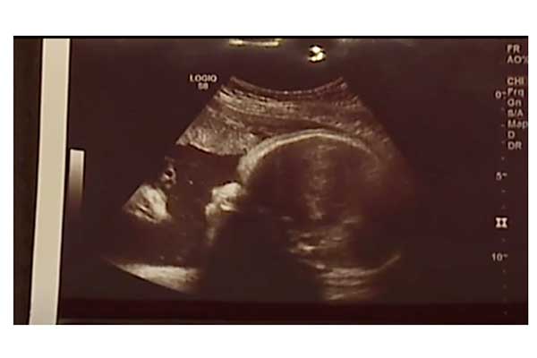 胎児エコー写真に写っていた驚きのモノとは 17年8月24日 ウーマンエキサイト