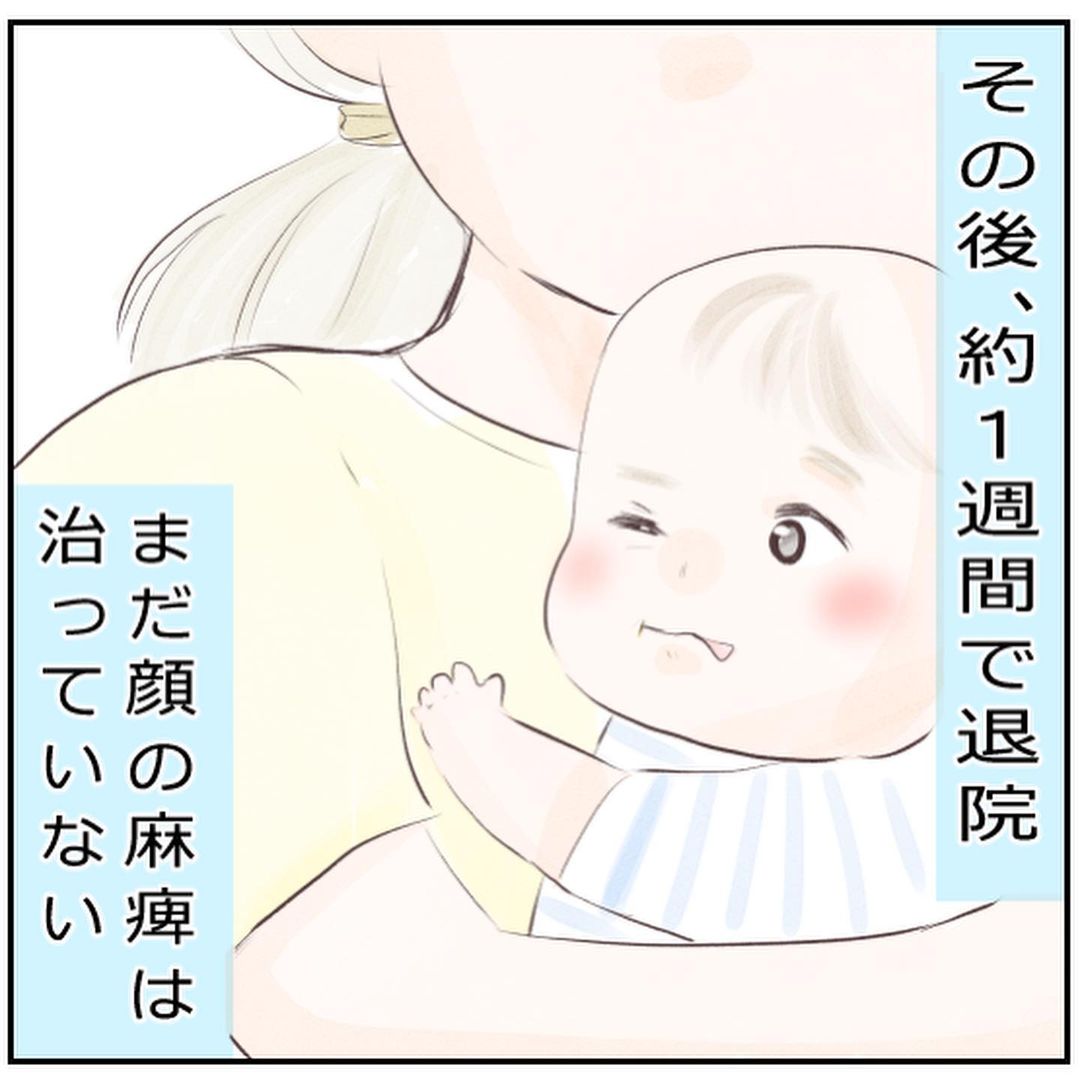 退院後もマッサージ 目薬でケア 1歳半になった息子は今 生後3ヶ月の息子が小児顔面麻痺に Vol 11 ウーマンエキサイト このお話は作者ようみんさんに寄せられたエ ｄメニューニュース Nttドコモ