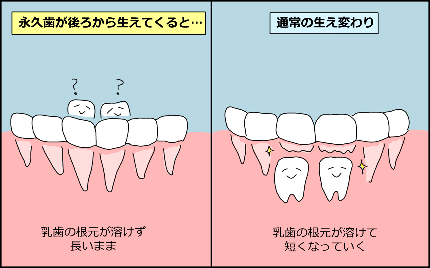 乳歯が長いまま埋もれていたそうです